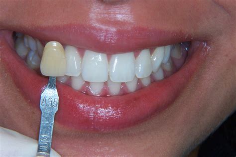 In these cases we have to use a newly developed bleaching shade guide which goes from lightest BL1, BL2, BL3 to BL4 which is very close to <b>B1</b>. . A3 to b1 teeth